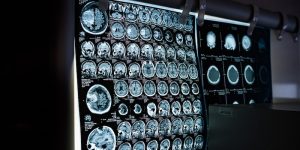 神经反馈与生物反馈