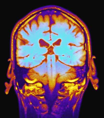 心理学中的顺行性遗忘：定义与例子